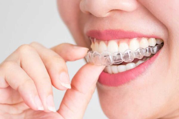 Orthodontics Clear Aligner