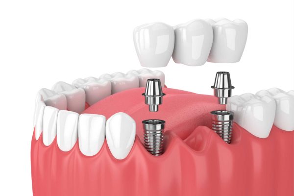 Implant